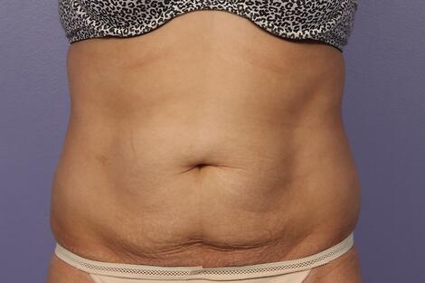 CoolSculpting Before & After Image