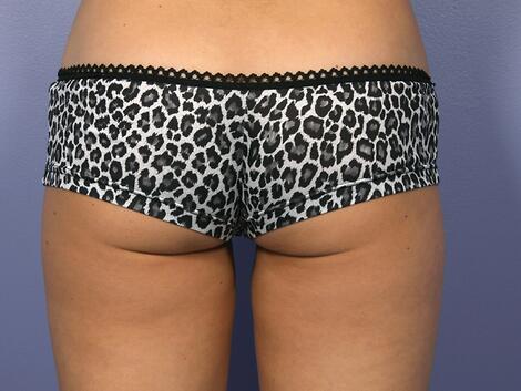 CoolSculpting Before & After Image