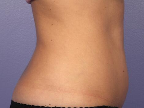 CoolSculpting Before & After Image