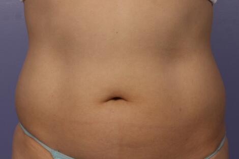 CoolSculpting Before & After Image