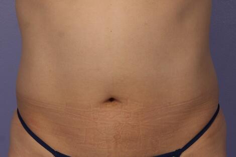 CoolSculpting Before & After Image