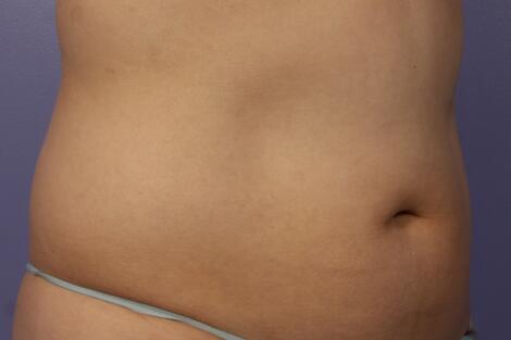 CoolSculpting Before & After Image