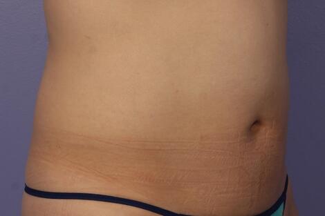 CoolSculpting Before & After Image