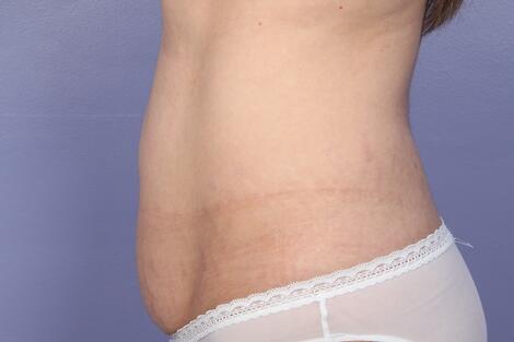 CoolSculpting Before & After Image