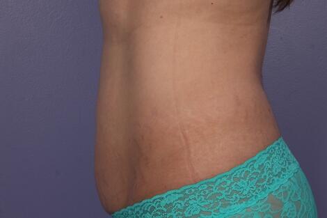 CoolSculpting Before & After Image