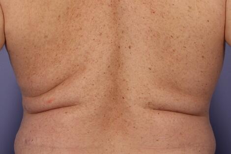 CoolSculpting Before & After Image