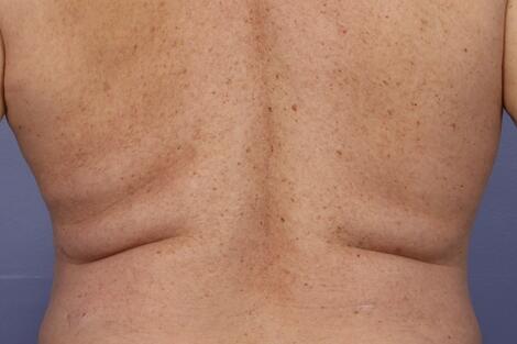 CoolSculpting Before & After Image