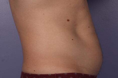 CoolSculpting Before & After Image