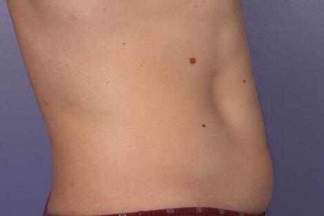 CoolSculpting Before & After Image