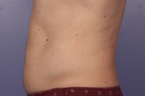 CoolSculpting Before & After Image