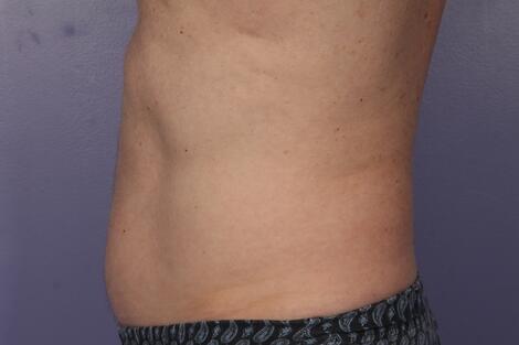 CoolSculpting Before & After Image