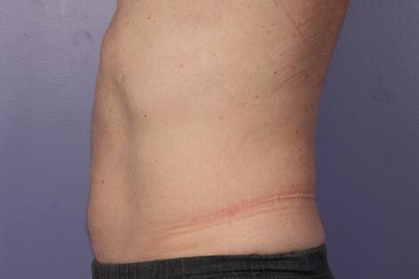 CoolSculpting Before & After Image