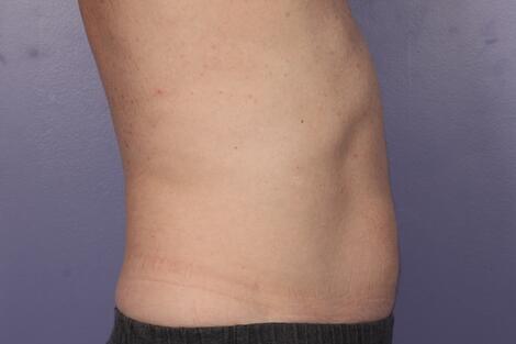 CoolSculpting Before & After Image