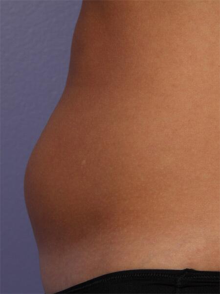 CoolSculpting Before & After Image