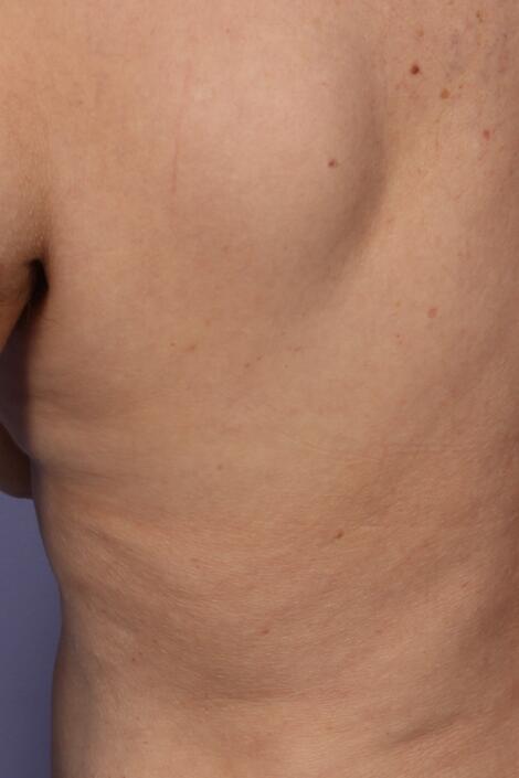 CoolSculpting Before & After Image