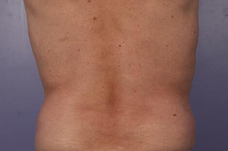 CoolSculpting Before & After Image