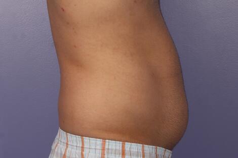 CoolSculpting Before & After Image