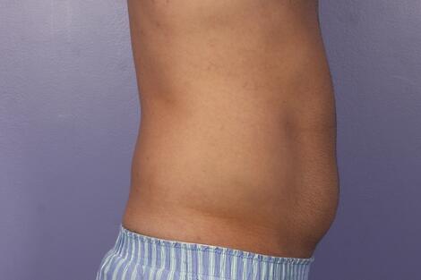 CoolSculpting Before & After Image