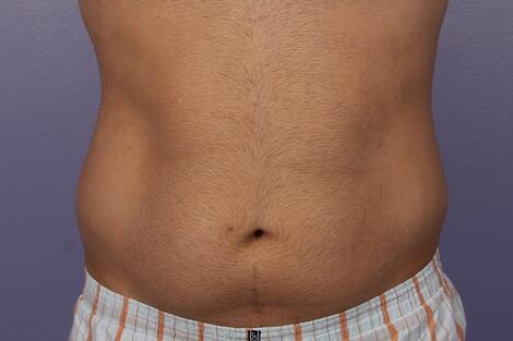 CoolSculpting Before & After Image