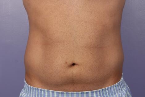 CoolSculpting Before & After Image