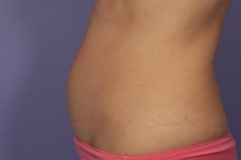 CoolSculpting Before & After Image