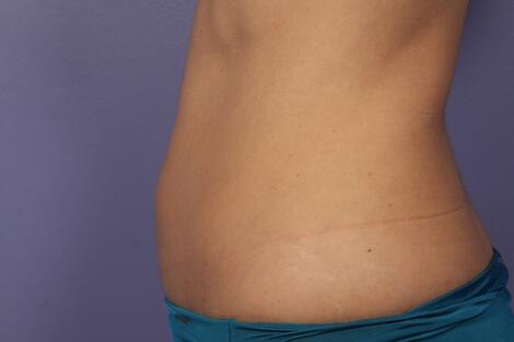 CoolSculpting Before & After Image