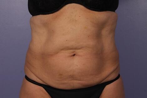 CoolSculpting Before & After Image