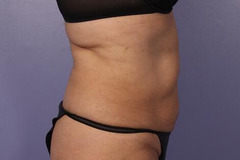 CoolSculpting Before & After Image