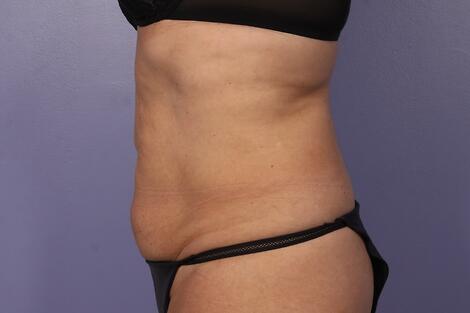 CoolSculpting Before & After Image