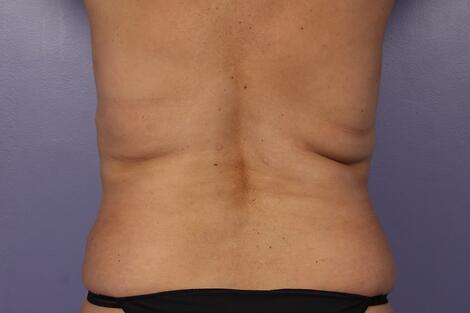 CoolSculpting Before & After Image