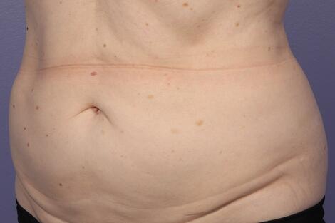 CoolSculpting Before & After Image