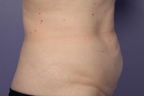 CoolSculpting Before & After Image