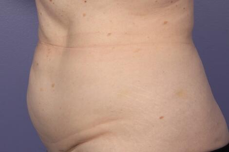 CoolSculpting Before & After Image