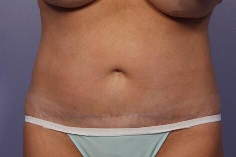 CoolSculpting Before & After Image