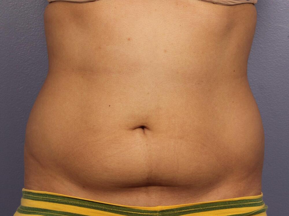 CoolSculpting Before & After Image