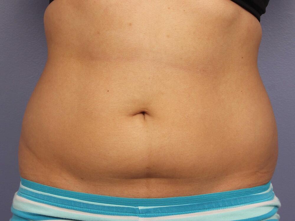 CoolSculpting Before & After Image