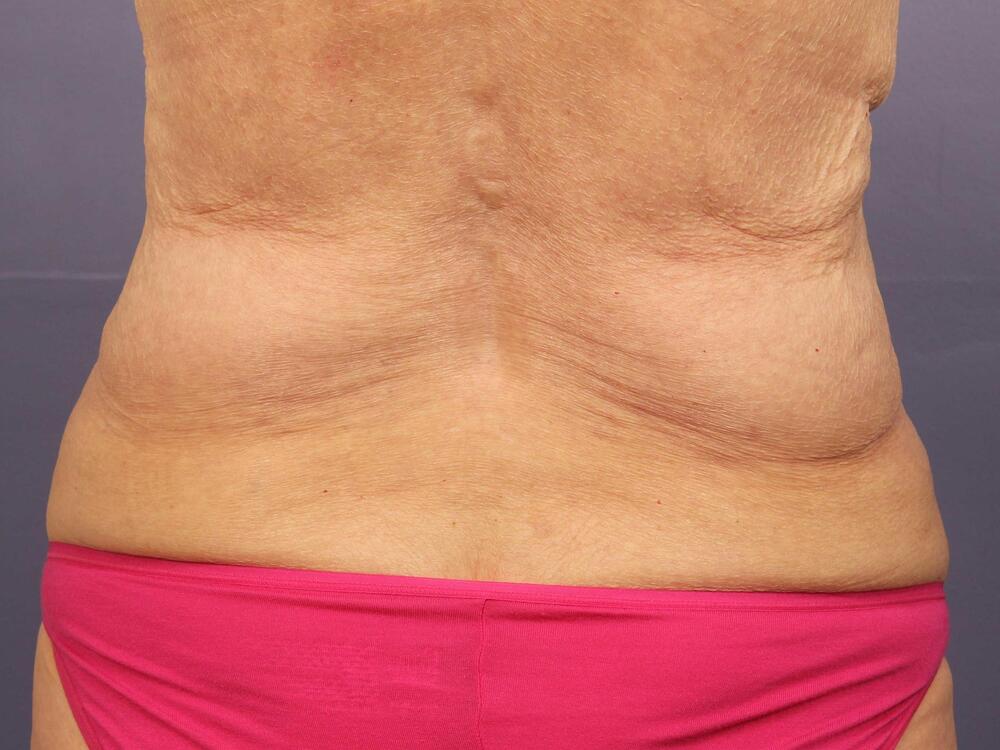 CoolSculpting Before & After Image