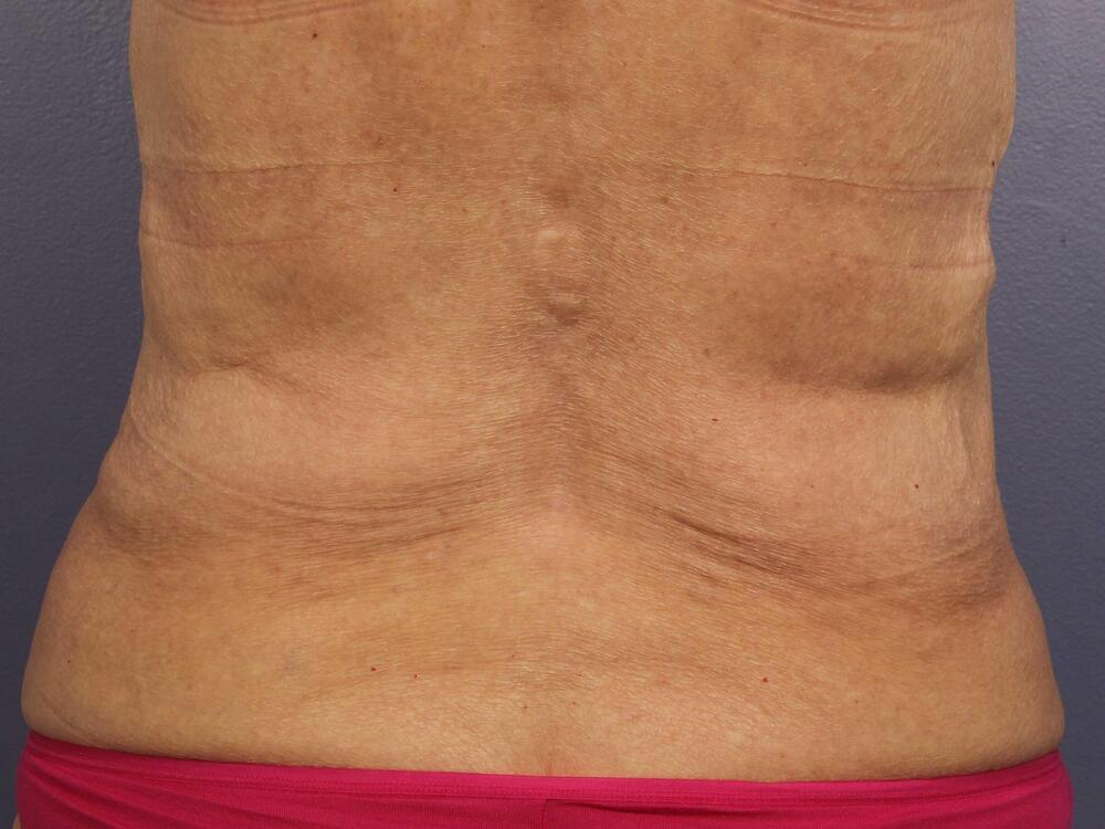 CoolSculpting Before & After Image