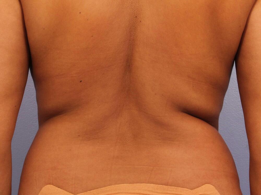 CoolSculpting Before & After Image