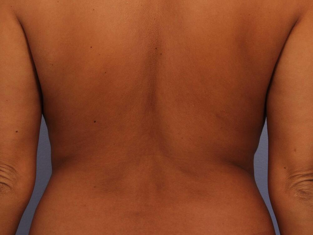 CoolSculpting Before & After Image