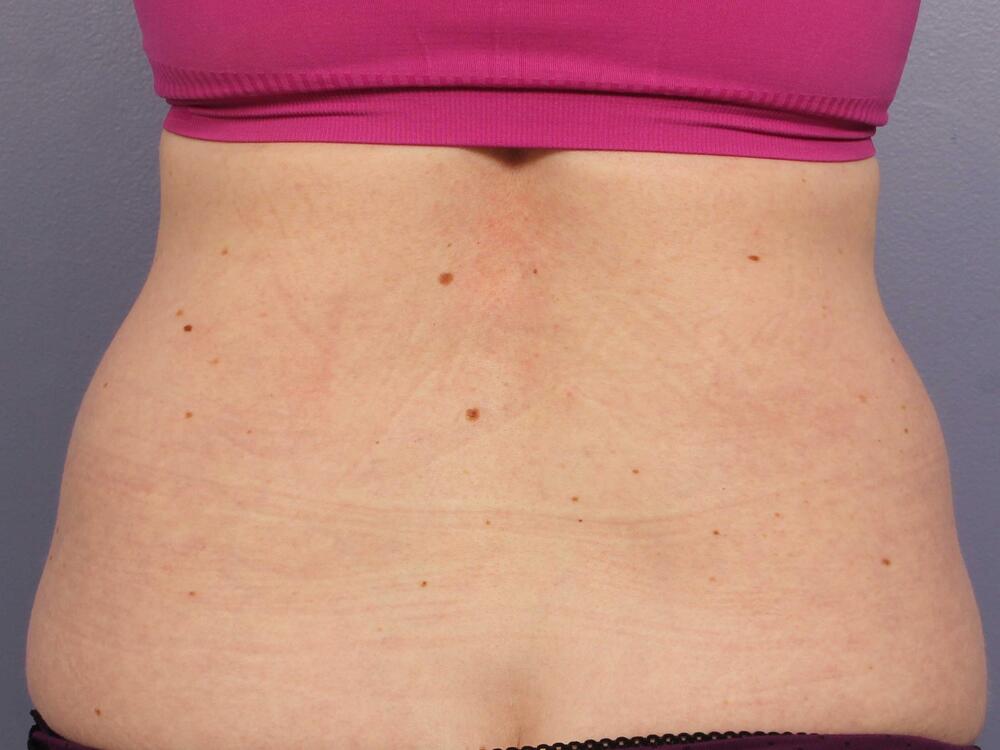 CoolSculpting Before & After Image