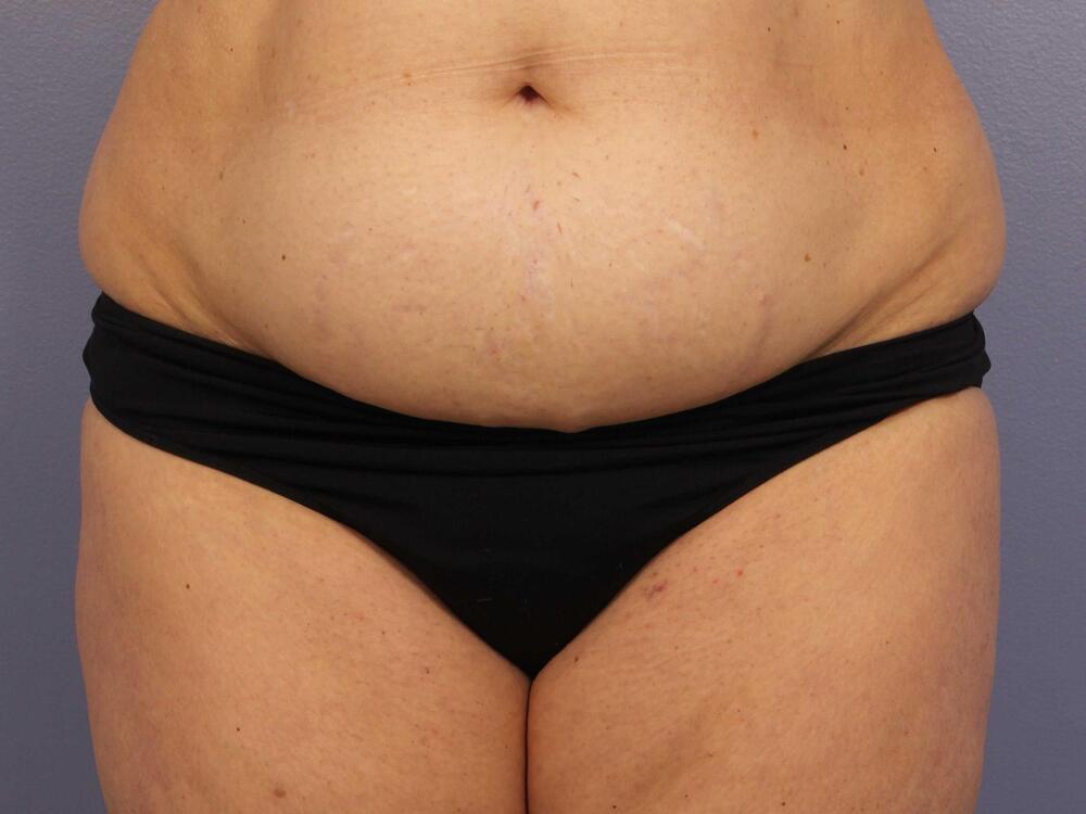 CoolSculpting Before & After Image