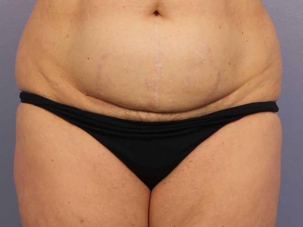 CoolSculpting Before & After Image