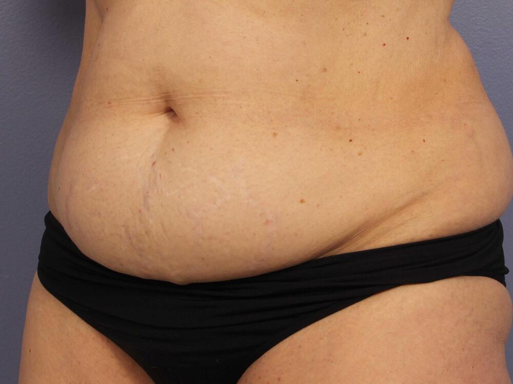 CoolSculpting Before & After Image