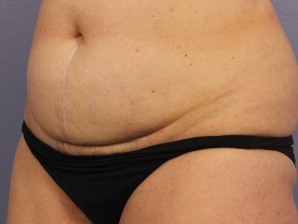 CoolSculpting Before & After Image