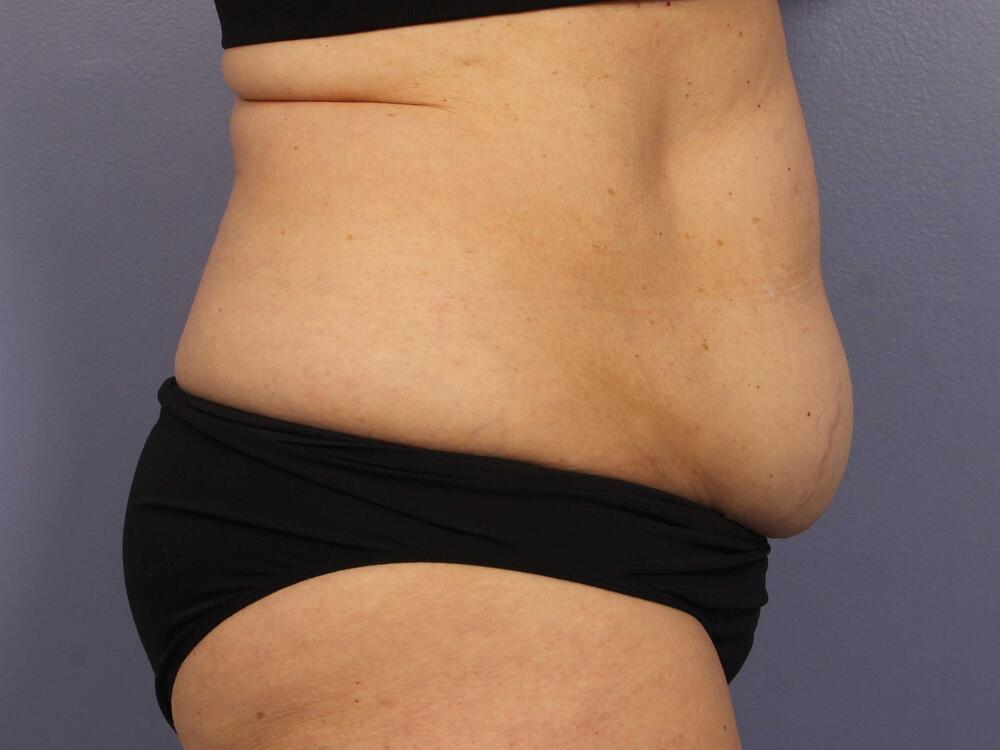 CoolSculpting Before & After Image