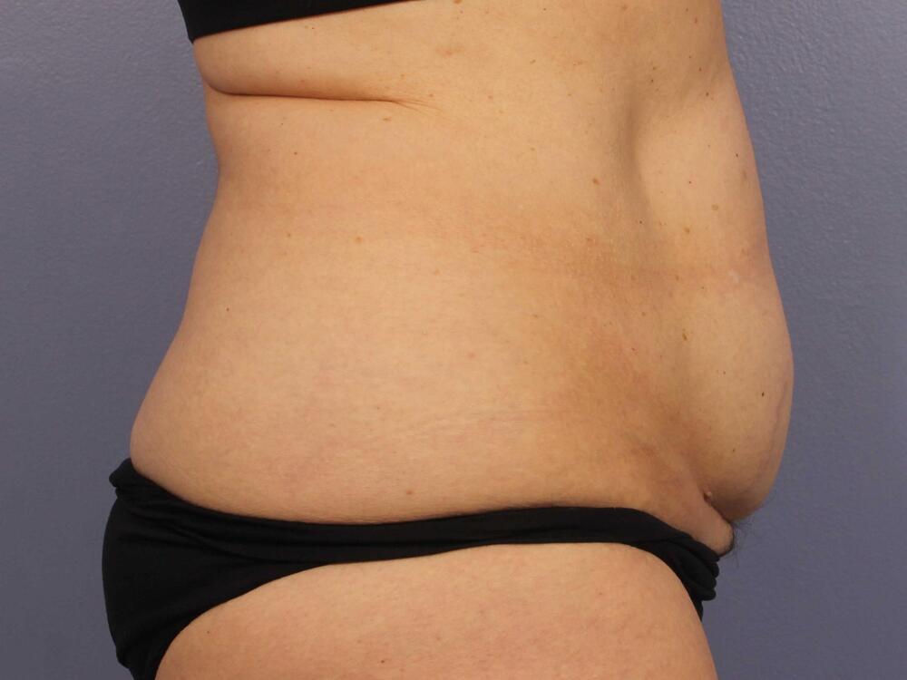 CoolSculpting Before & After Image