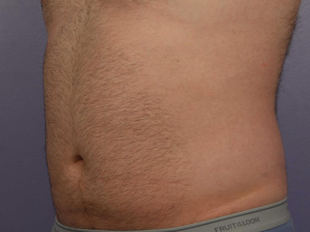 CoolSculpting Before & After Image