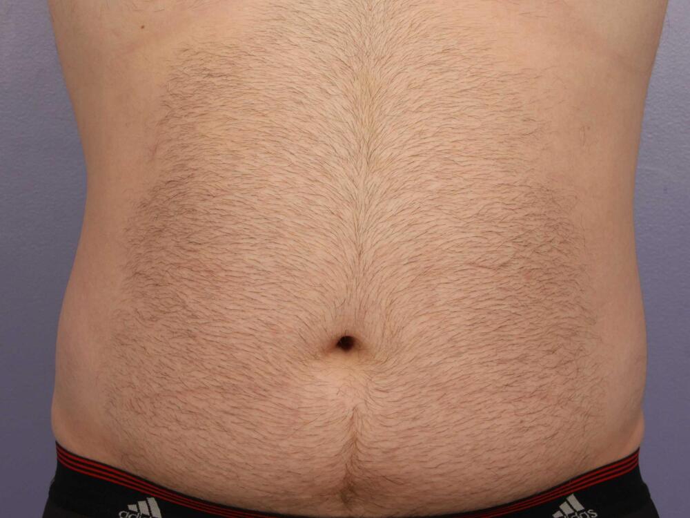 CoolSculpting Before & After Image