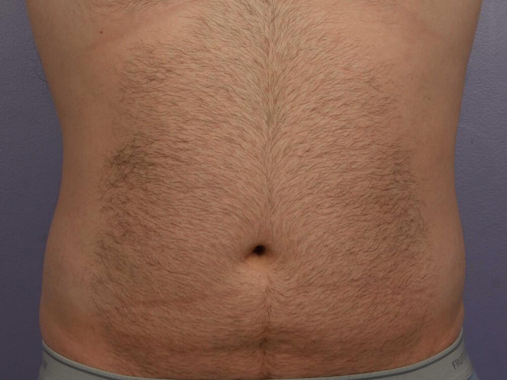 CoolSculpting Before & After Image